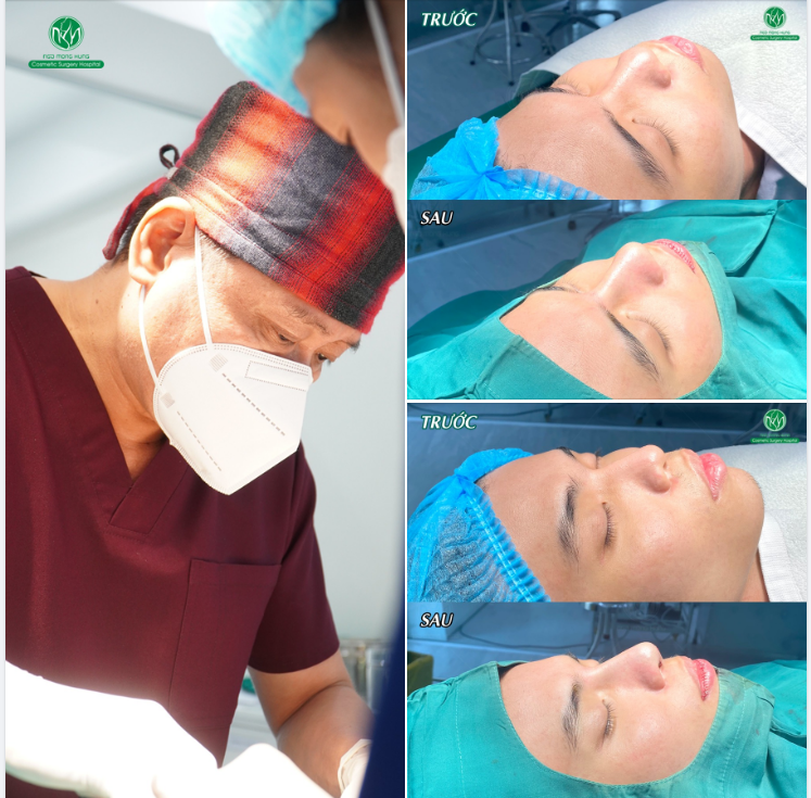 THÊM MỘT KẾT QUẢ SAU NÂNG MŨI