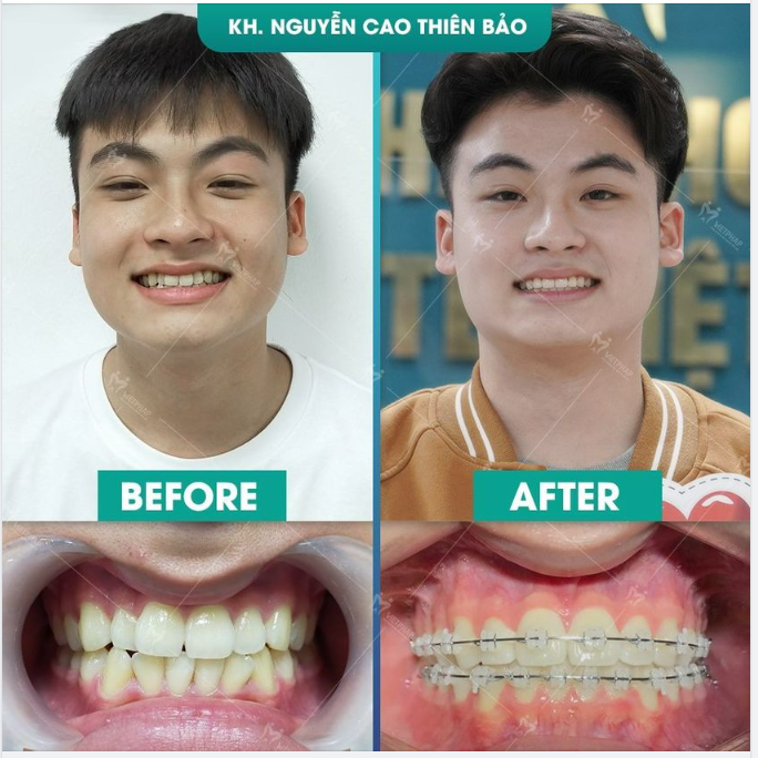THIẾT KẾ NỤ CƯỜI TỪ VIỆC NIỀNG RĂNG