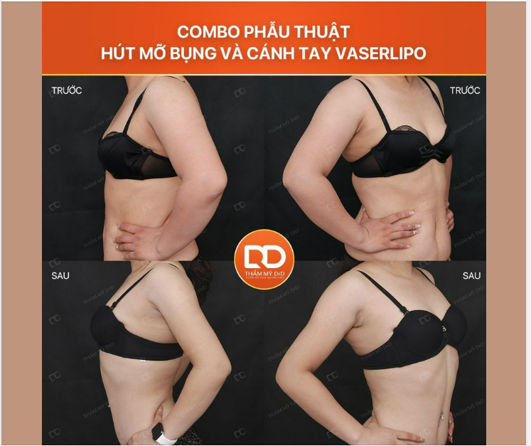 THỰC HIỆN COMBO HÚT MỠ CÁNH TAY VÀ BỤNG TRONG CÙNG 1 LẦN ĐƯỢC KHÔNG