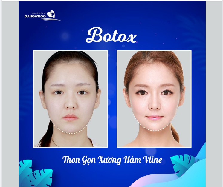 TIÊM BOTOX THON GỌN HÀM  LÀM ĐẸP KHÔNG PHẪU THUẬT