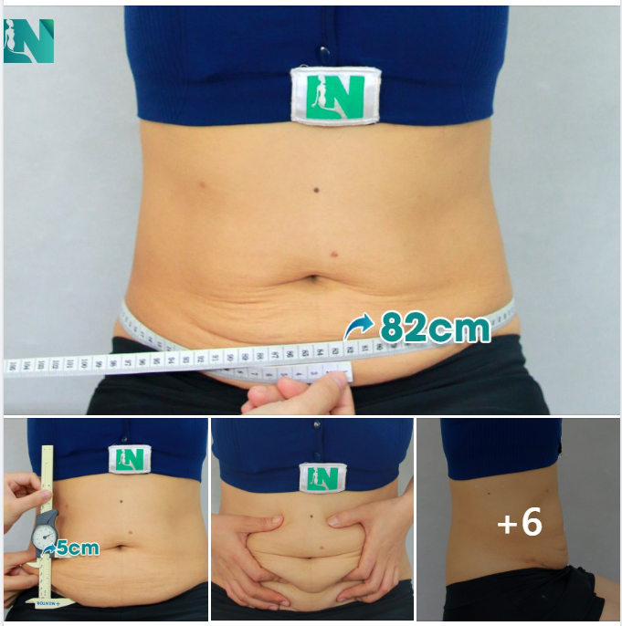TÌM LẠI DÁNG VÓC THANH XUÂN CHO CHỊ KH 38 TUỔI, 4 LẦN SINH NỞ VỚI  HÚT MỠ TẠO DÁNG THẨM MỸ KẾT HỢP  CẤY MỠ NGỰC.