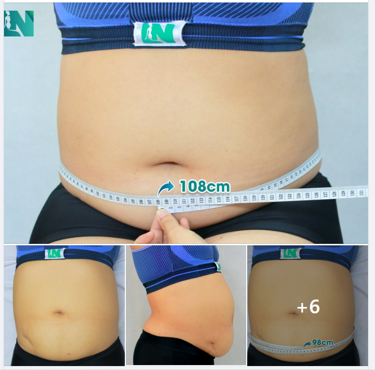 TÌM LẠI VÒNG EO NHỎ GỌN KHÔNG CAN THIỆP CĂNG DA CHO CHỊ KH (40 TUỔI) ĐẾN TỪ CÀ MAU VÒNG BỤNG HƠN 1 MÉT, CHẢY XỆ NẶNG, TRỰC TIẾP 15H00 – 15H30 HÔM NAY