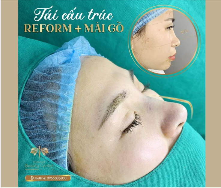 Tình trạng ban đầu của khách hàng sống mũi thấp, gồ nhiều, đầu mũi kéo khoằm khiến cho tỉ lệ gương mặt mất cân đối.
