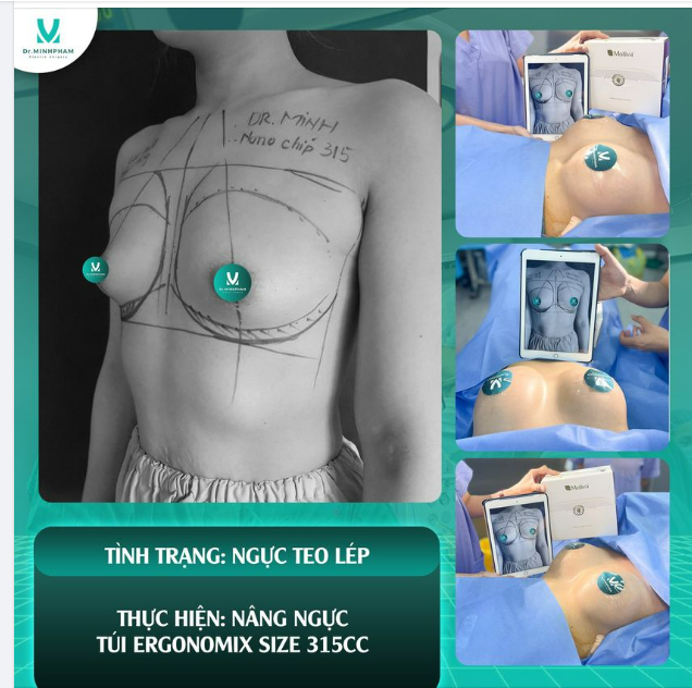 Tình trạng THIỂU SẢN TUYẾN NGỰ.C 90% các bà mẹ gặp phải sau quá trình sinh con.