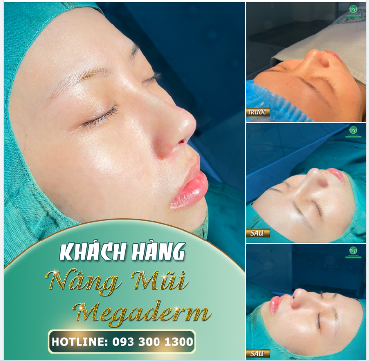 TỚI BỆNH VIỆN NÂNG MŨI LÀ CHỈ CÓ ĐẸP