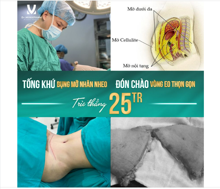 Tống khứ bụng m.ỡ nhăn nheo - Đón chào vòng eo thon gọn