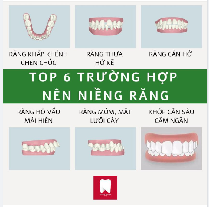 TOP 6 TRƯỜNG HỢP NÊN NIỀNG RĂNG 