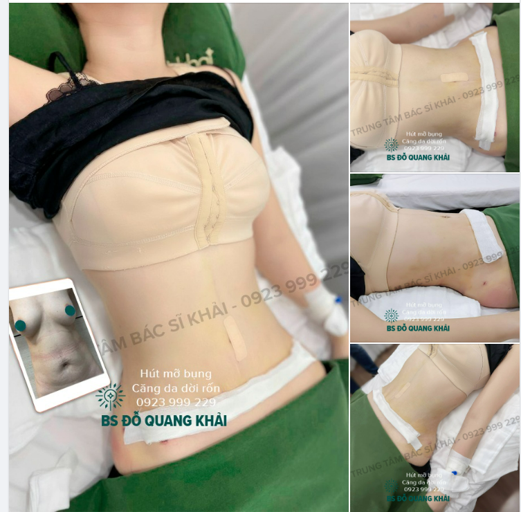 TRẢ THÀNH PHẨM CHO KHÁCH HÀNG SAU 7 NGÀY HÚT MỠ CĂNG DA DỜI RỐN tại bs Đỗ Quang Khải