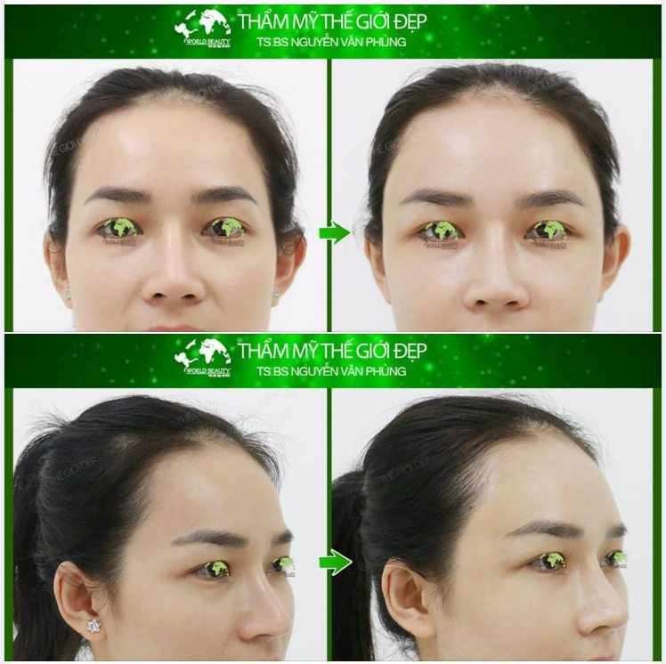 TRẺ HÓA DIỆN MẠO bằng MỠ TỰ THÂN
