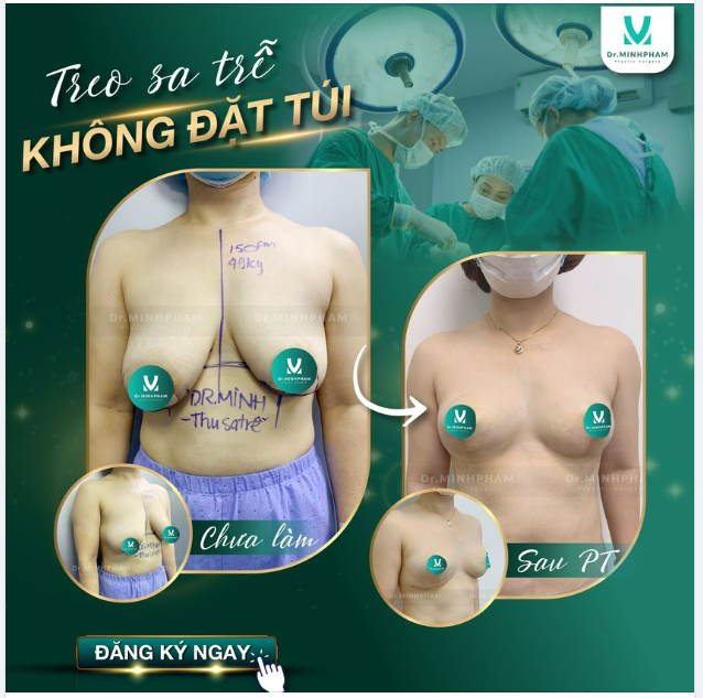 TREO NGỰC SA TRỄ - LẤY LẠI QUYẾN RŨ TUỔI XUÂN