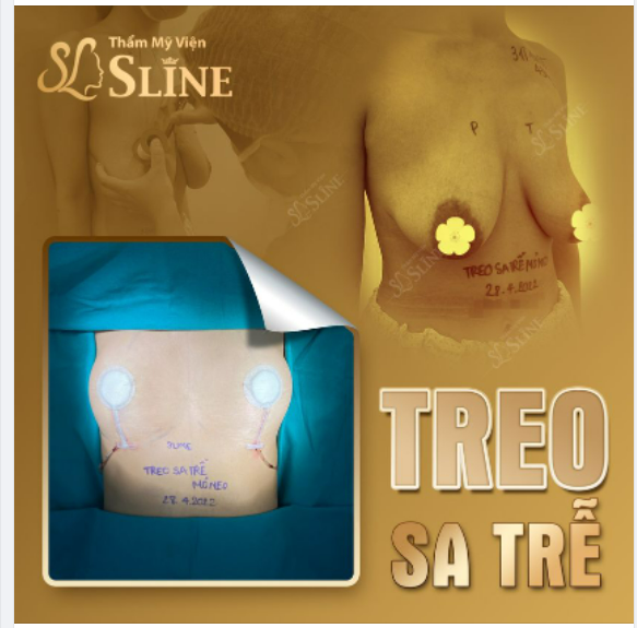 TREO NGỰC SA TRỄ - TÁI SINH VÒNG 1.