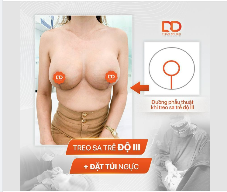 Treo sa trễ độ III kết hợp đặt túi ngực được thực hiện như thế nào