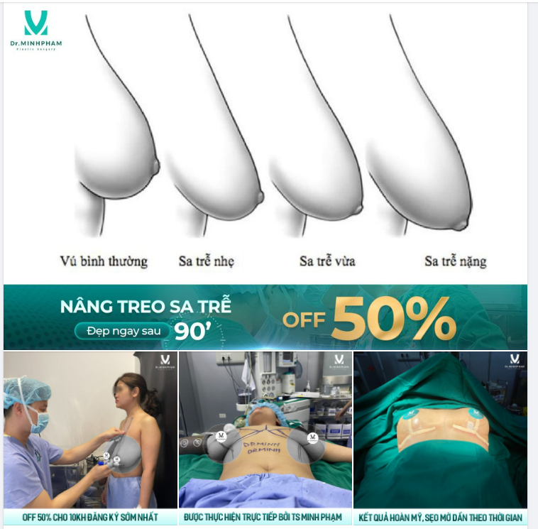 Treo sa trễ - Lấy lại V1 căng tròn mềm mại