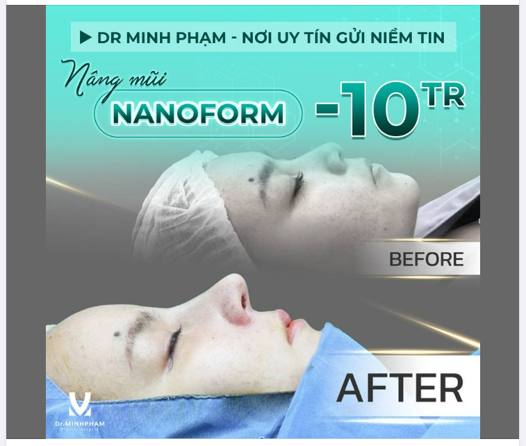 ​​​​​​​ Trọn vẹn chia sẻ và diện mạo mới của khách hàng vừa nâng mũi. Mọi người cùng ngắm nhìn kết quả nhé!