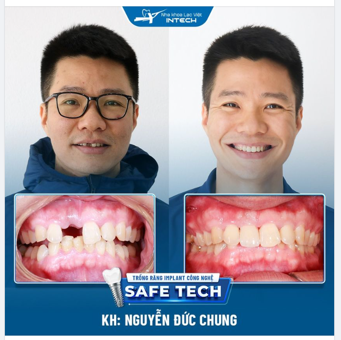 TRỒNG RĂNG IMPLANT CÔNG NGHỆ SAFE-TECH: ĂN NHAI NHƯ RĂNG THẬT