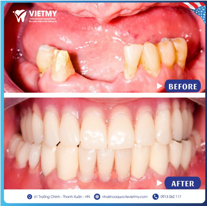 TRỒNG RĂNG IMPLANT - GIẢI PHÁP AN TOÀN CHO NGƯỜI MẤT RĂNG TOÀN HÀM