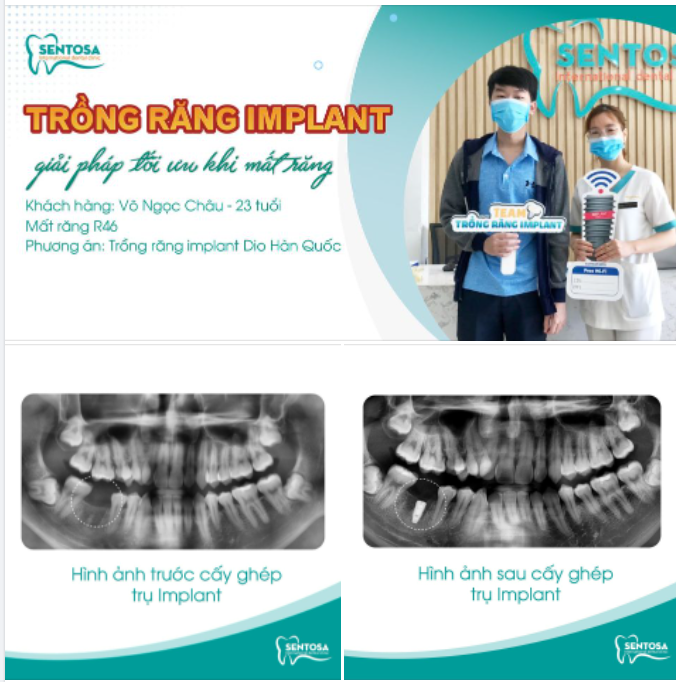 TRỒNG RĂNG IMPLANT - GIẢI PHÁP TỐI ƯU KHI MẤT RĂNG