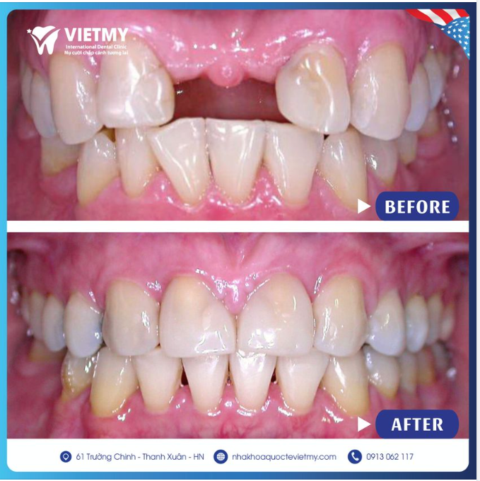 TRỒNG RĂNG IMPLANT TÁI TẠO NỤ CƯỜI- AN TOÀN - HIỆU QUẢ