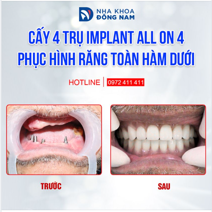 TRỒNG RĂNG KHÔNG ĐAU BẰNG MẤT RĂNG