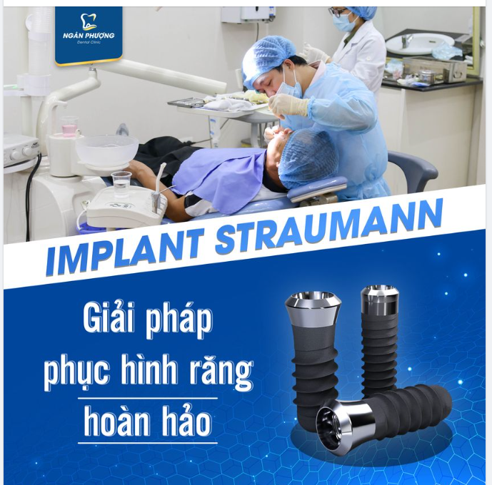 TRỤ IMPLANT STRAUMANN THUỴ SĨ- GIẢI PHÁP PHỤC HÌNH RĂNG HOÀN HẢO