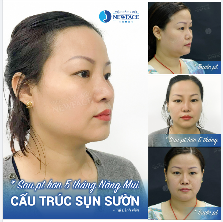 TRƯỚC MẶT DỮ NÂNG MŨI XONG HIỀN RA BAO NHIÊU LUÔN BÁC SĨ ƠI!