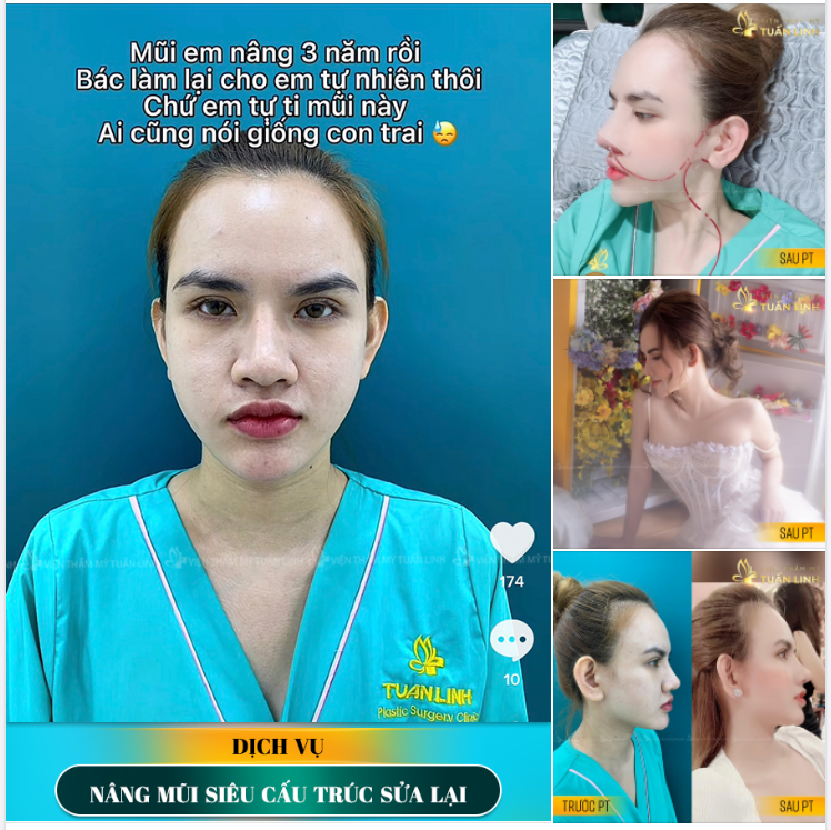 TỰ TI VỚI MŨI CŨ INBOX NGAY CHO TUẤN LINH ĐỂ SỞ HỮU DÁNG MŨI MỚI SIÊU ĐẸP NHÉ.