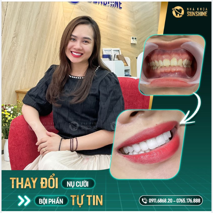 Tự tin là nha khoa thiết kế nụ cười được rất nhiều khách hàng tin tưởng lựa chọn.