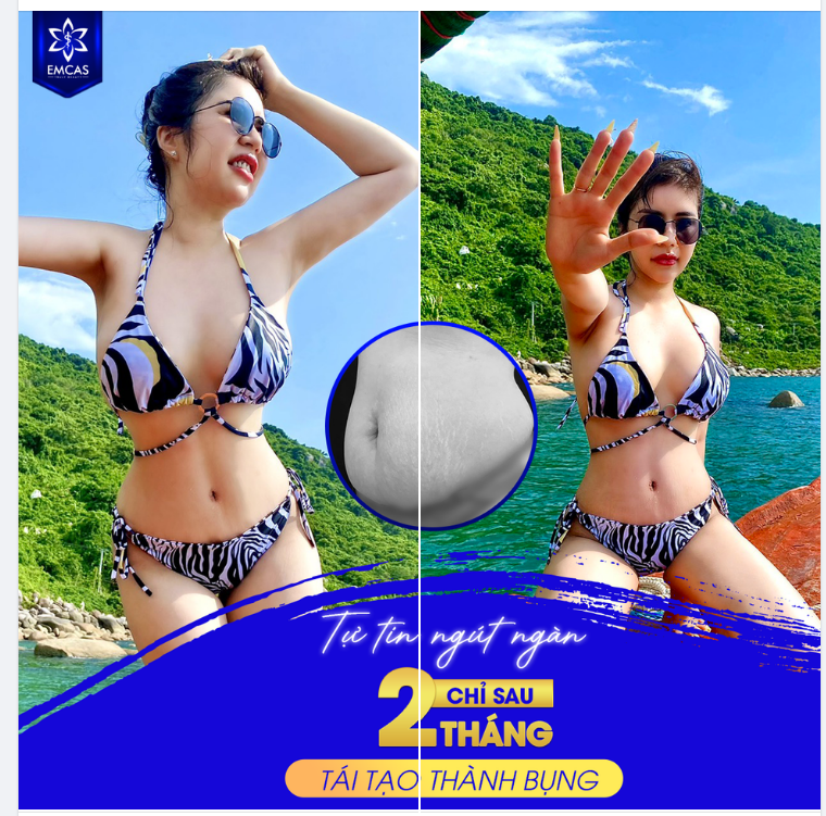 TỰ TIN NGÚT NGÀN CHỈ SAU 2 THÁNG TÁI TẠO THÀNH BỤNG