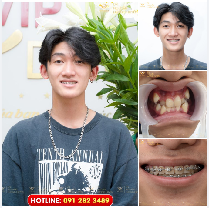 TỪNG CÓ MỘT HÀM RĂNG "BẮT BUỘC PHẢI NHỔ RĂNG MỚI NIỀNG ĐẸP"