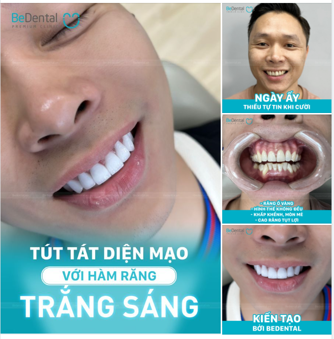 Tút tát lại diện mạo với hàm răng trắng sáng