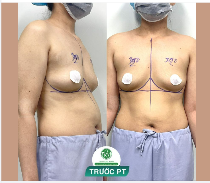 U40 NÂNG NGỰC SẼ NHƯ THẾ NÀO