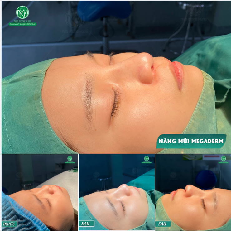 ƯU ĐÃI NÂNG MŨI MEGADERM CHỈ 12,5 TRIỆU
