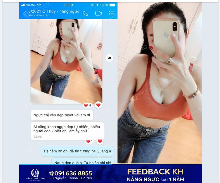 V1 của khách hàng nhà VQ sau 1 năm thực hiện. Ng ực đẹp, dáng xinh thì ai cũng mê. Đúng không cả nhà