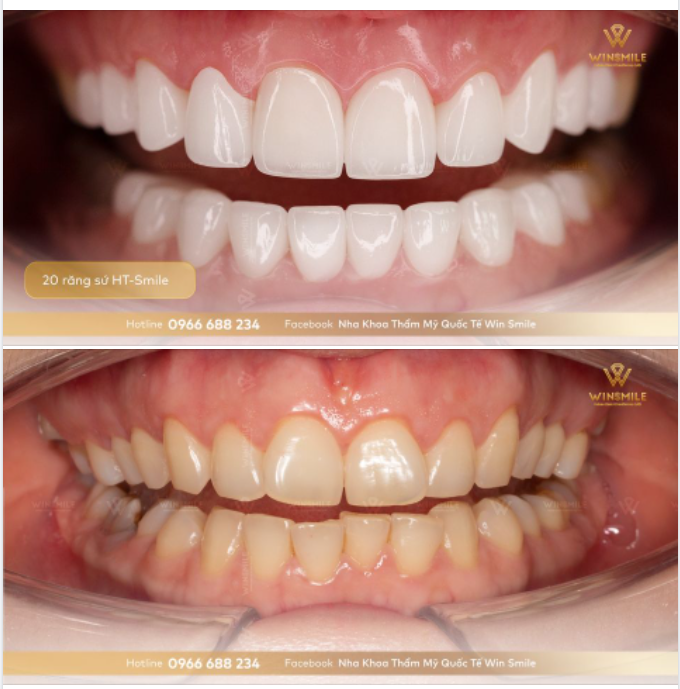VẺ ĐẸP HOÀN HẢO VỚI SIÊU PHẨM HT-SMILE 