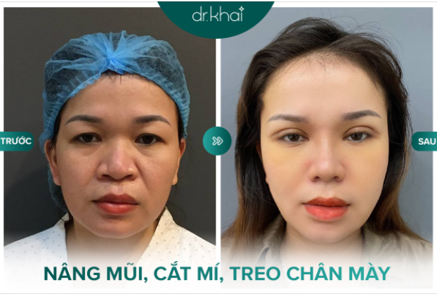 Vẻ đẹp sau khi phẫu thuật treo chân mày và Cắt mí
