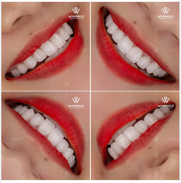 VẺ ĐẸP TỰ NHIÊN, GHI ĐIỂM TUYỆT ĐỐI VỚI RĂNG SỨ HT SMILE