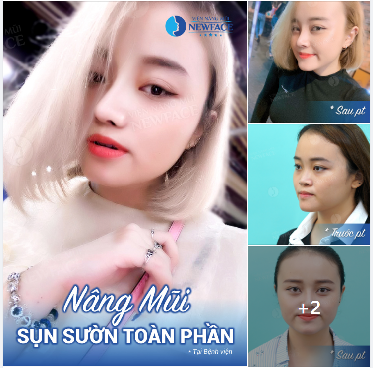 VÌ MẸ ANH BẮT CHIA TAY…Nên Em Đi Nâng Mũi Liền Cho Bỏ Tức