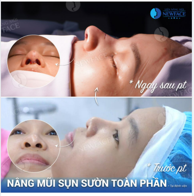 “Vì mình quá thích mũi cậu rồi phải làm sao phải làm sao”