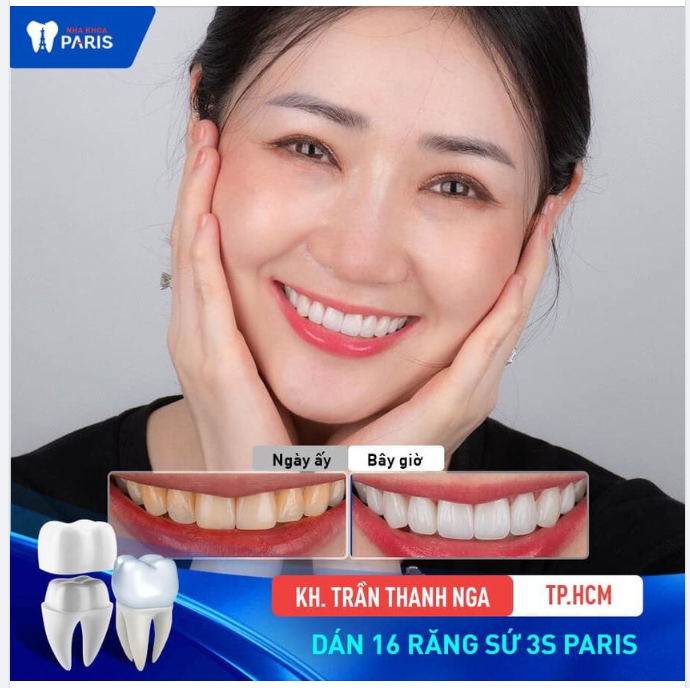 VÌ SAO DÁN SỨ VENEER ĐANG TRỞ NÊN CỰC HOT?