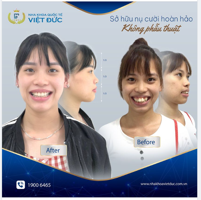 VÌ SAO LẠI NIỀNG RĂNG - VÌ NÓ XỨNG ĐÁNG!!!