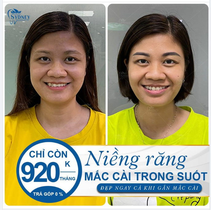 VÌ SAO NÊN LỰA CHỌN NIỀNG RĂNG 