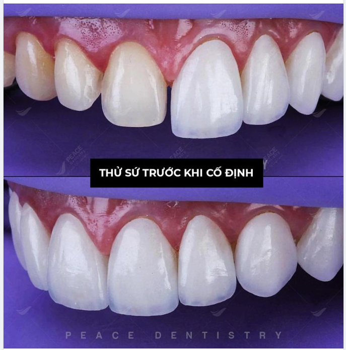 VÌ SAO PHẢI THỬ SỨ TRƯỚC KHI CỐ ĐỊNH?