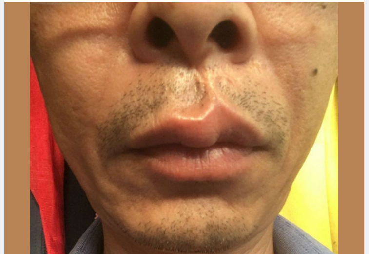 Việc chữa trị các sẹo ở vùng môi thường khó khăn hơn sửa chữa các sẹo ở vị trí khác của vùng mặt, đòi hỏi những kiến thức chuyên sâu và kinh nghiệm của bác sĩ điều trị.