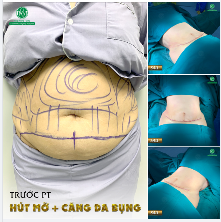 VÒNG EO THON GỌN, SĂN CHẮC SAU HÚT MỠ +CĂNG DA BỤNG TẠI BVTM NGÔ MỘNG HÙNG
