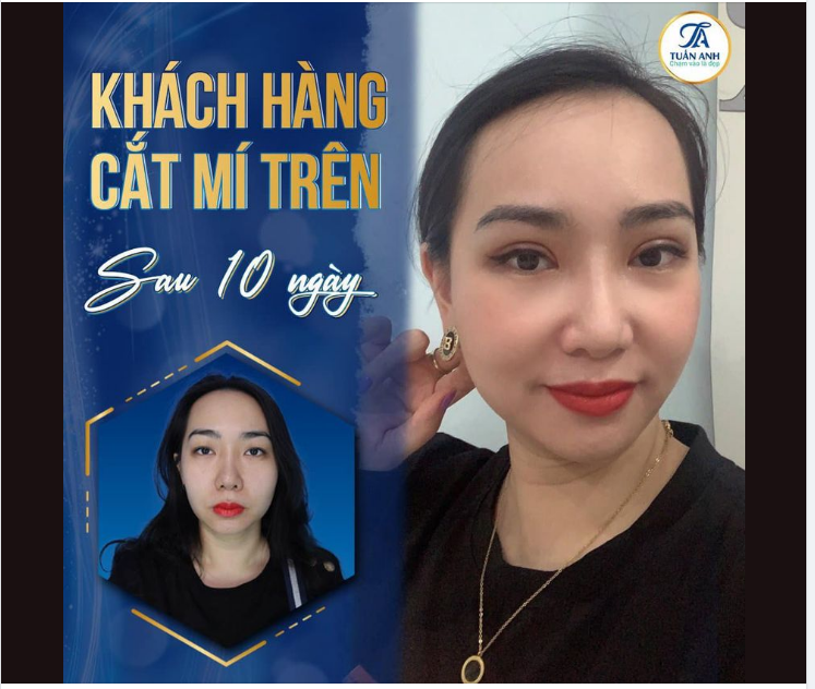 Xinh hơn, trẻ hơn chỉ sau 10 ngày thực hiện Cắt mí trên tại Thẩm Mỹ Tuấn Anh