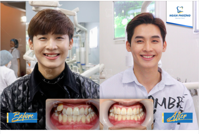 Xoá sổ hàm răng khấp khểnh, tút lại vẻ đẹp trai cho “quý ông đại chiến" Kang Chul (Nguyễn Văn Phương)