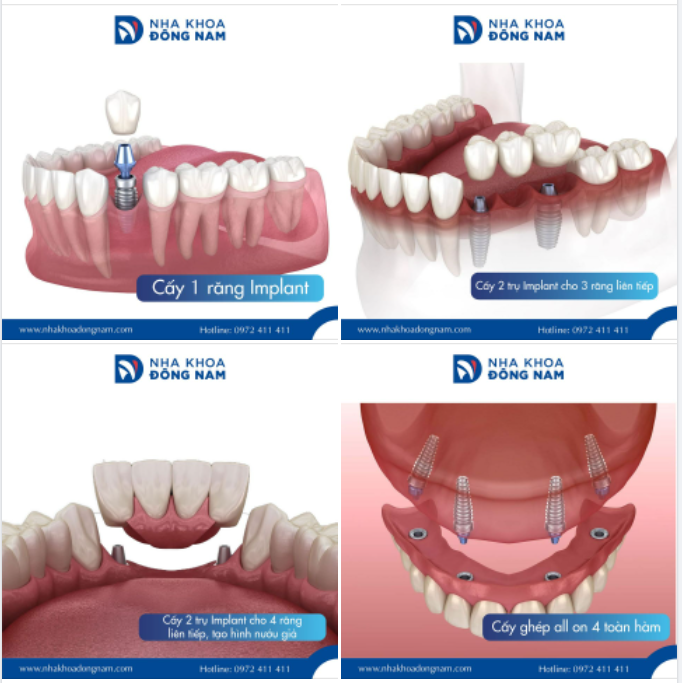 XƯƠNG HÀM SẼ BỊ TIÊU ĐI NẾU KHÔNG CÒN CHÂN RĂNG