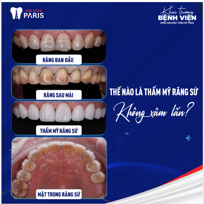 04 TIÊU CHÍ THẨM MỸ RĂNG SỨ KHÔNG XÂM LẤN BẠN CẦN BIẾT