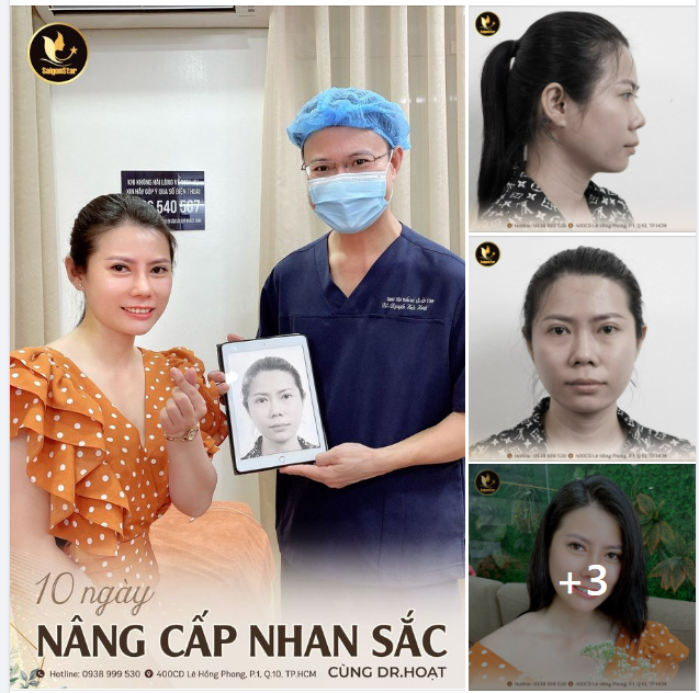 10 NGÀY NÂNG CẤP NHAN SẮC CÙNG DR. HOẠT COMBO NÂNG MŨI CẤU TRÚC + ĐỘN CẰM