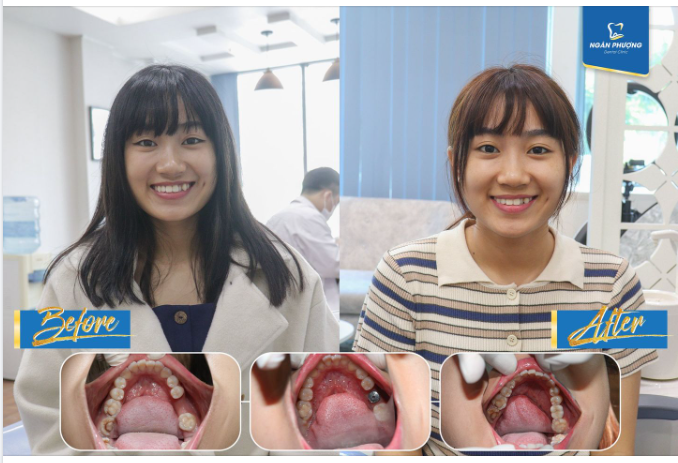 1,2,3,5 hô biến biến từ những con ốc vít thành những chiếc răng xinh